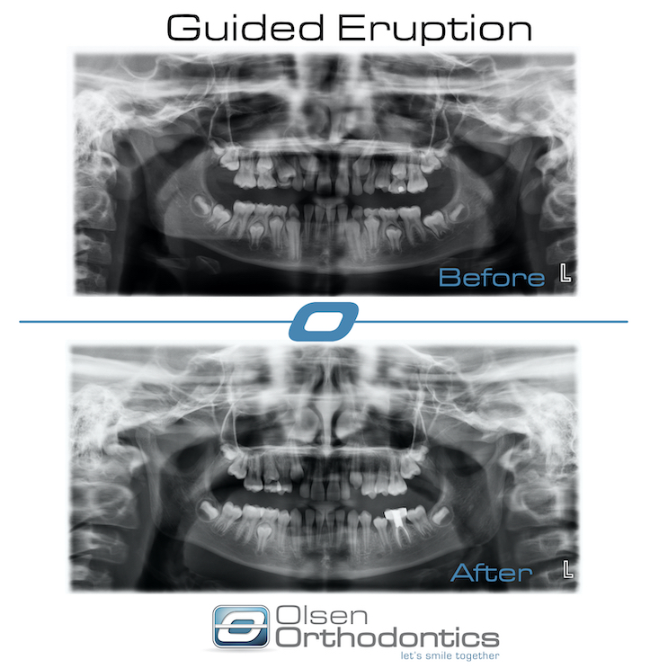 GUIDED ERUPTIION