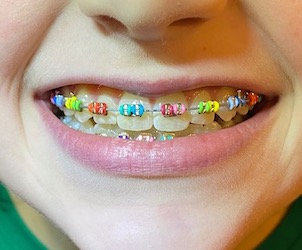 BracesType